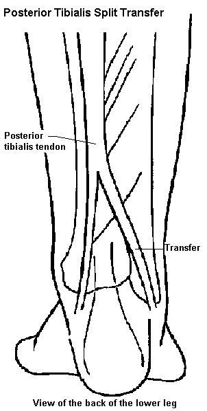 tibialis posterior lengthening